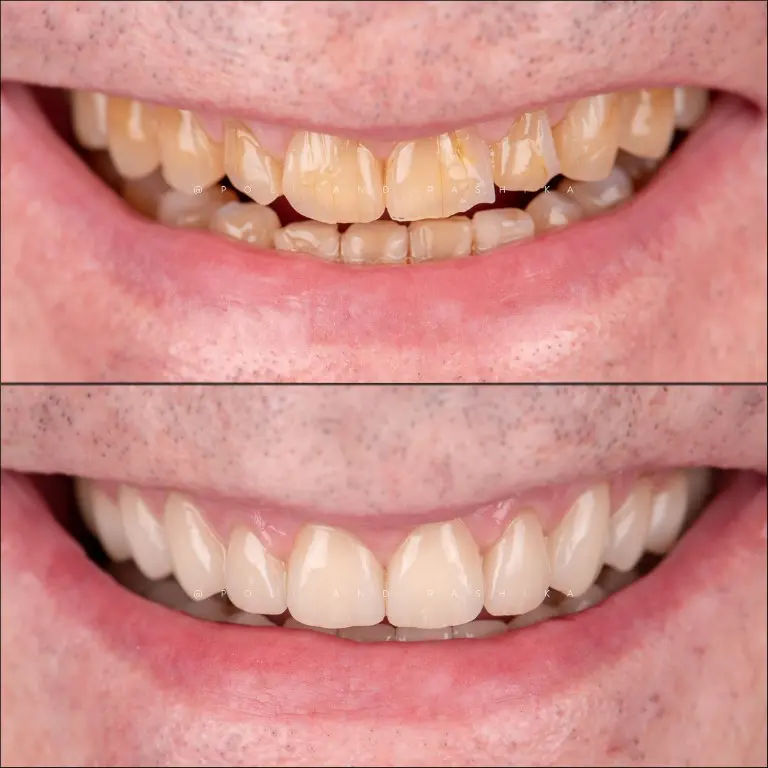 Before And After Enamel Erosion Dental Crowns (medium)