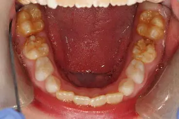 hypomineralised teeth