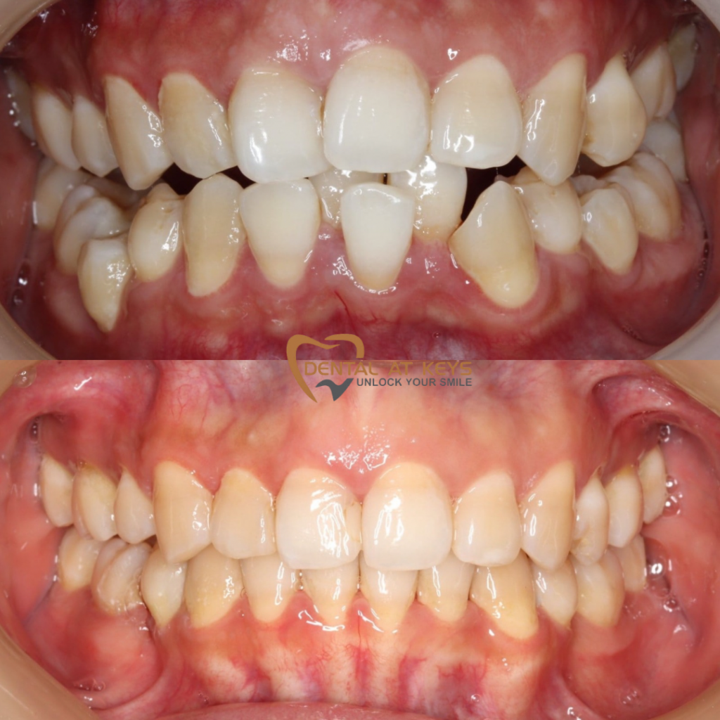 Invsbeforeafter