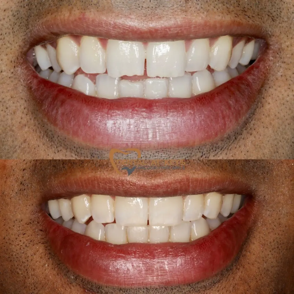 Invsbeforeafter