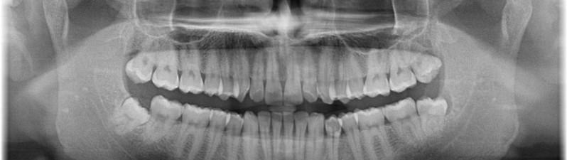 Why are Dental X-rays so important?