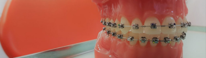 When can I start Orthodontics (Braces) for my kids? [Early Braces]