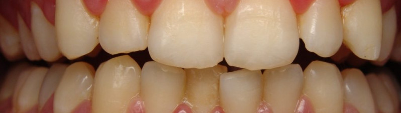 Gum disease? Sounds terrible! What is it?
