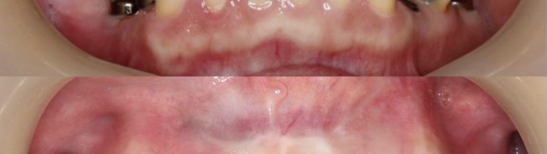 Before&After – Dental Implants