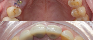 Dental Implant B/A