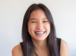 Smiling asian girls braces - orthodontics - why choose us - keysborough dentist - dental at keys