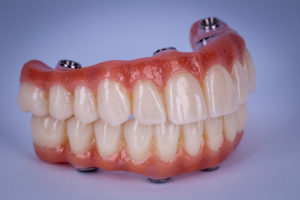 all-on-4 dental implant dental at keys keysborough dentist