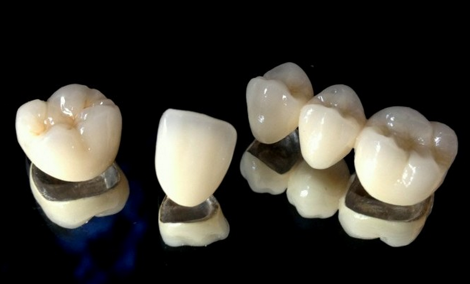 The Dental Crown question answered: To crown or not to crown?