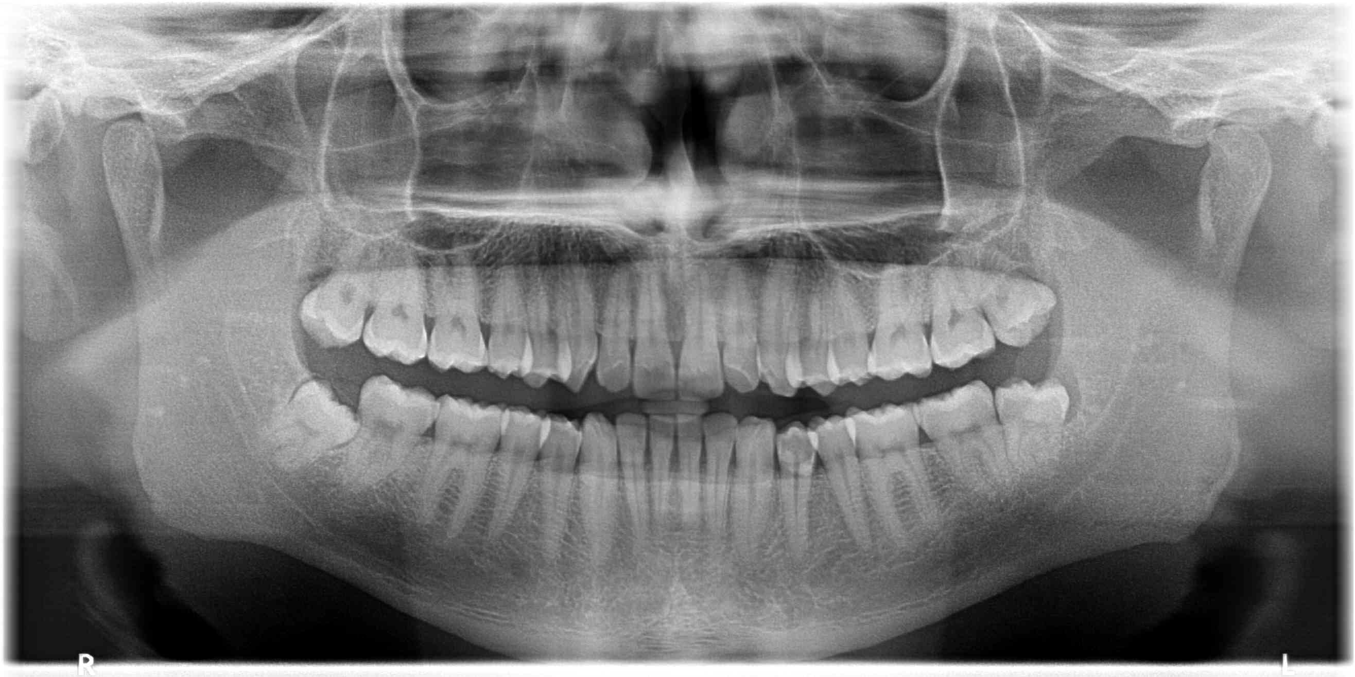 Why are Dental X-rays so important?