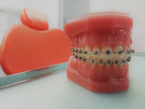 early braces orthodontics