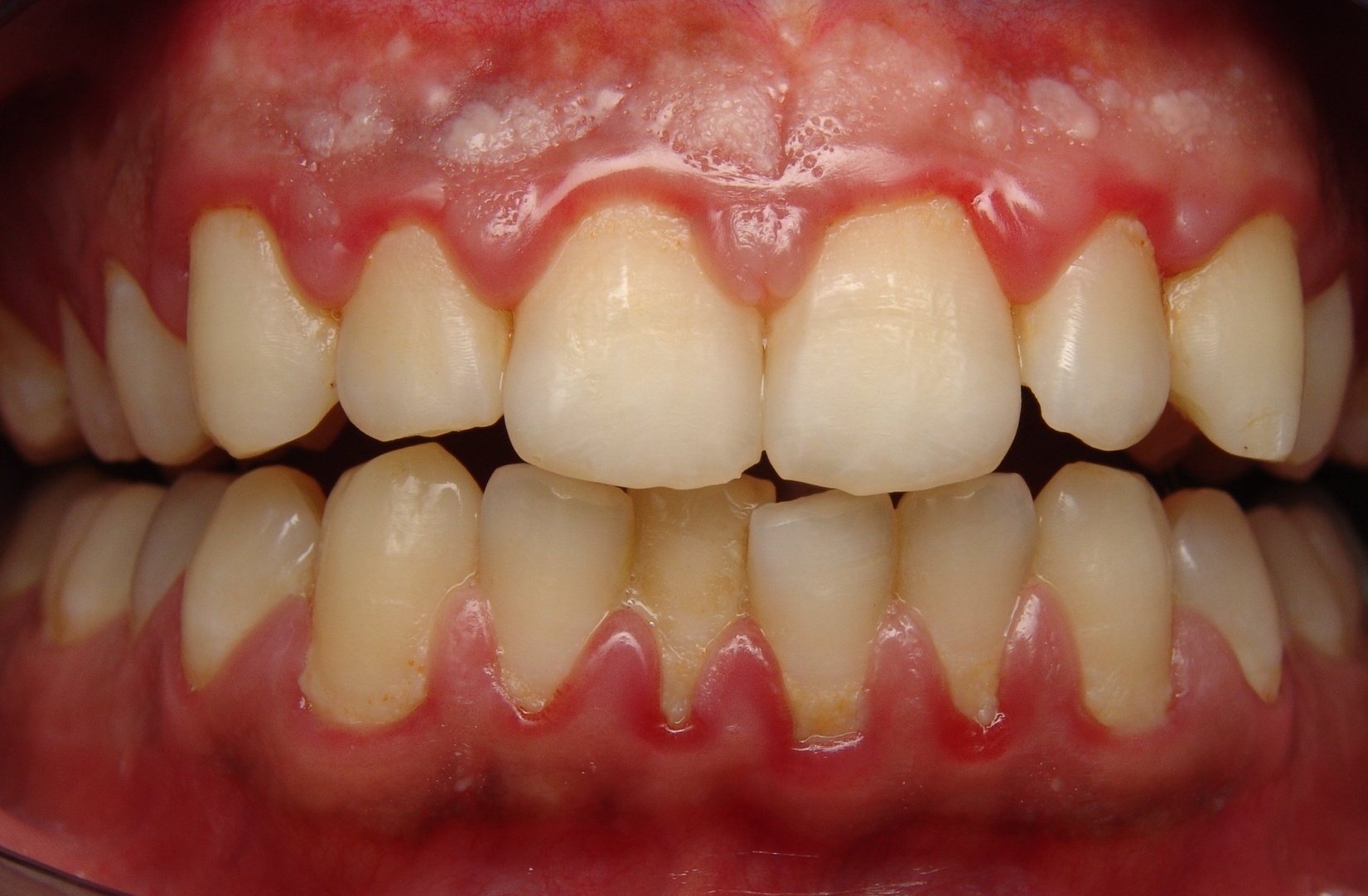 Gum disease? Sounds terrible! What is it?