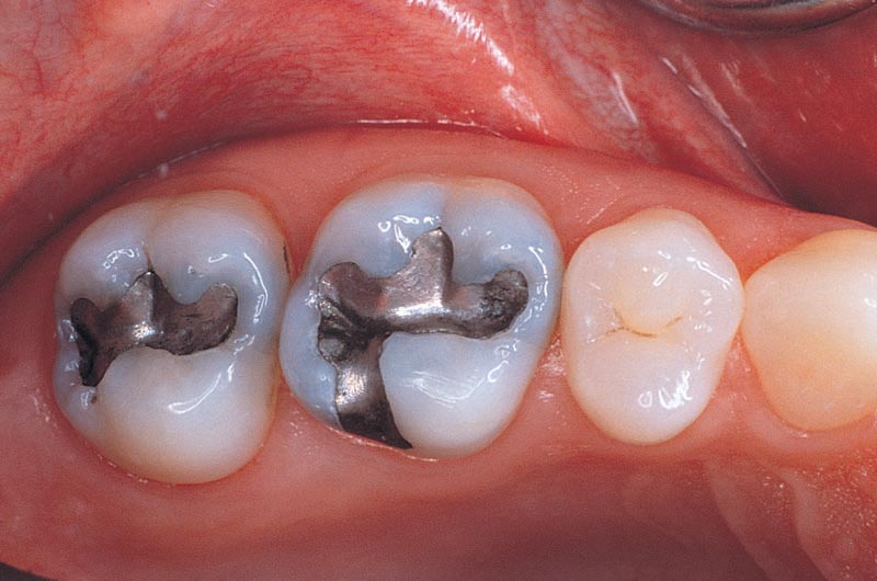 Amalgam fillings- are they bad for me?