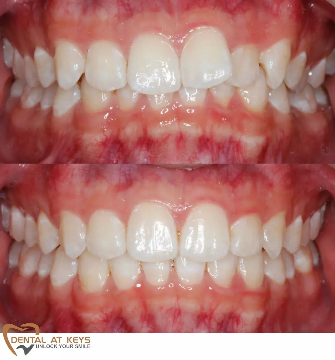 Invisalign – Before | After