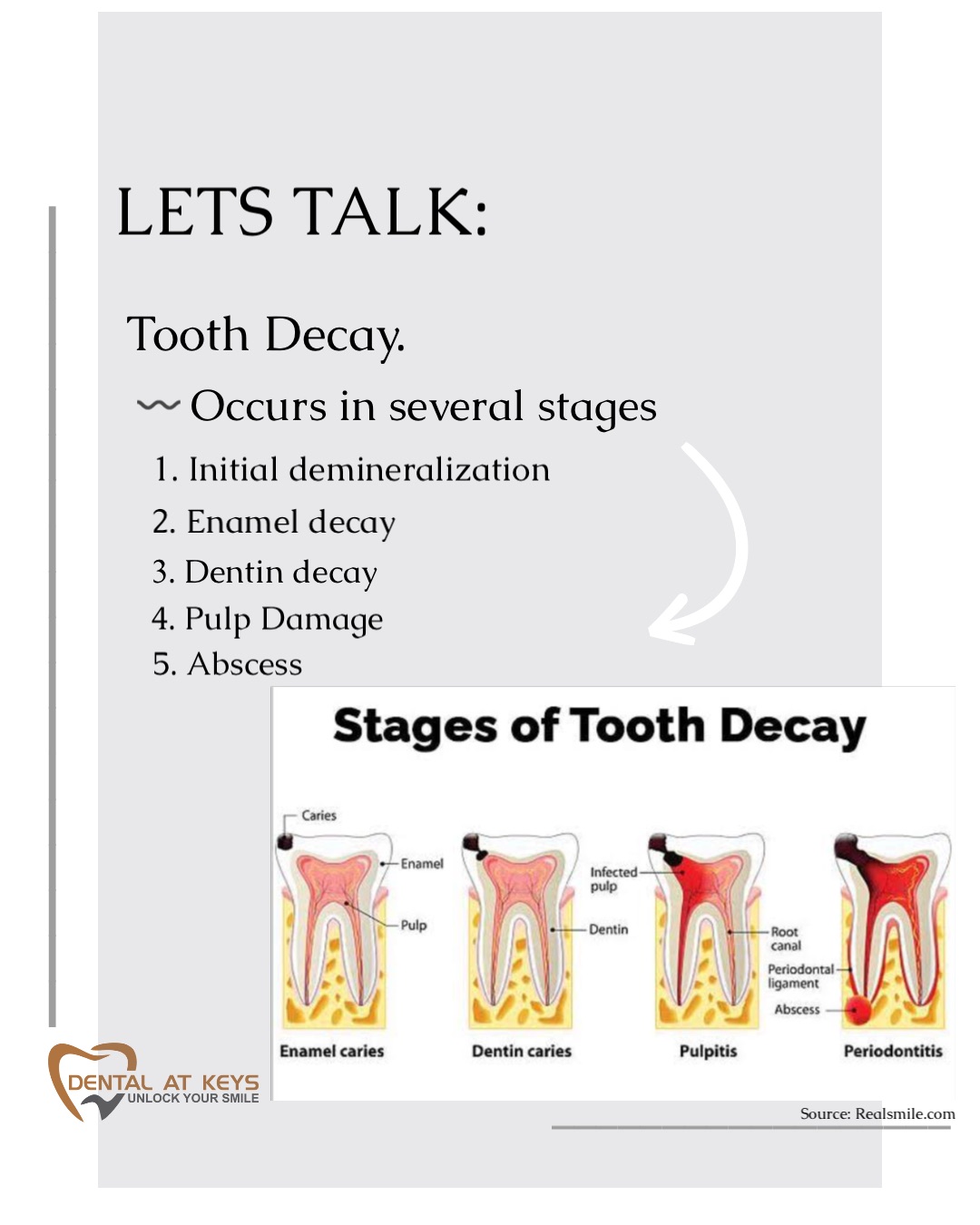 Tooth Decay