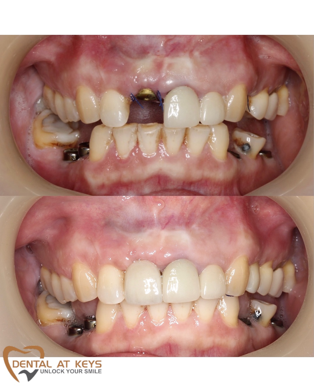 Before&After – Dental Implants