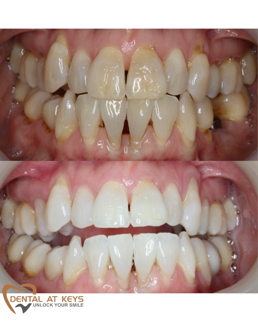 Teeth Whitening B/A