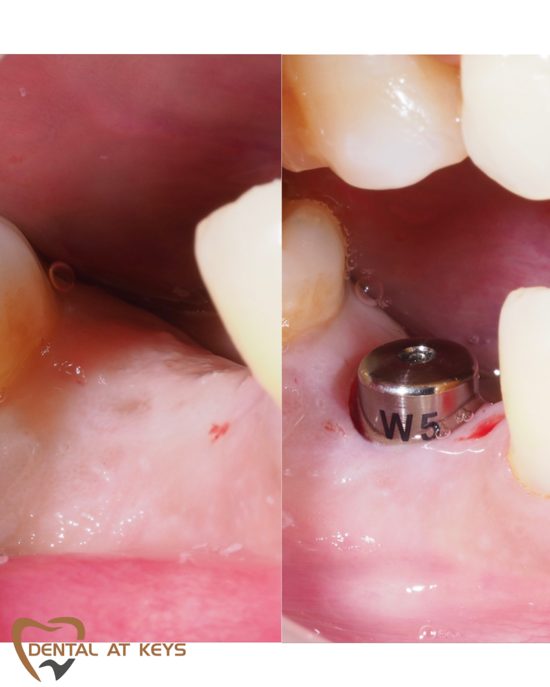 Dental Implants