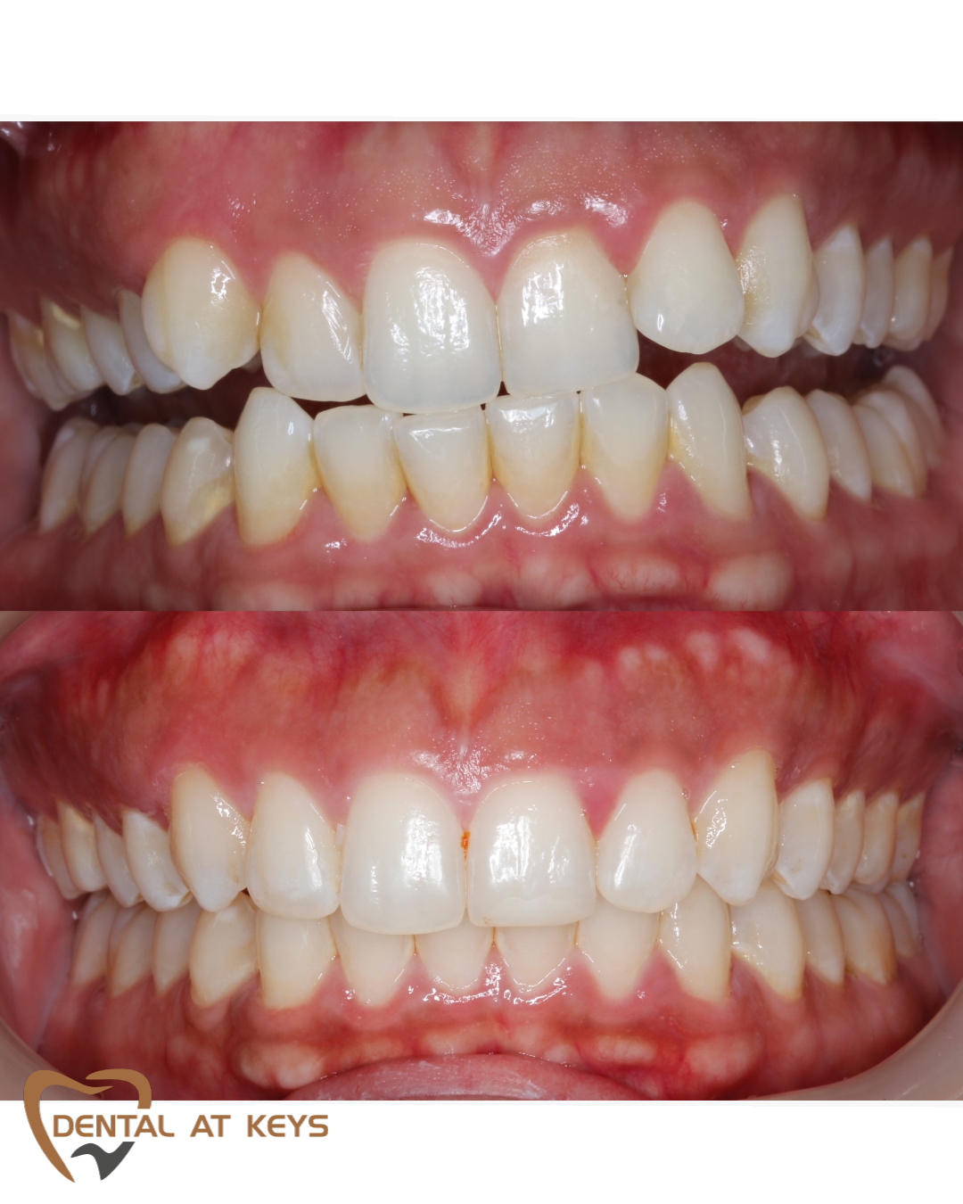 Invisalign Before/After