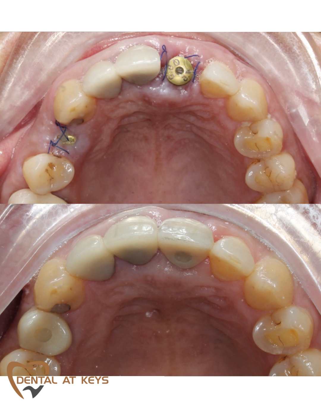 Dental Implant B/A