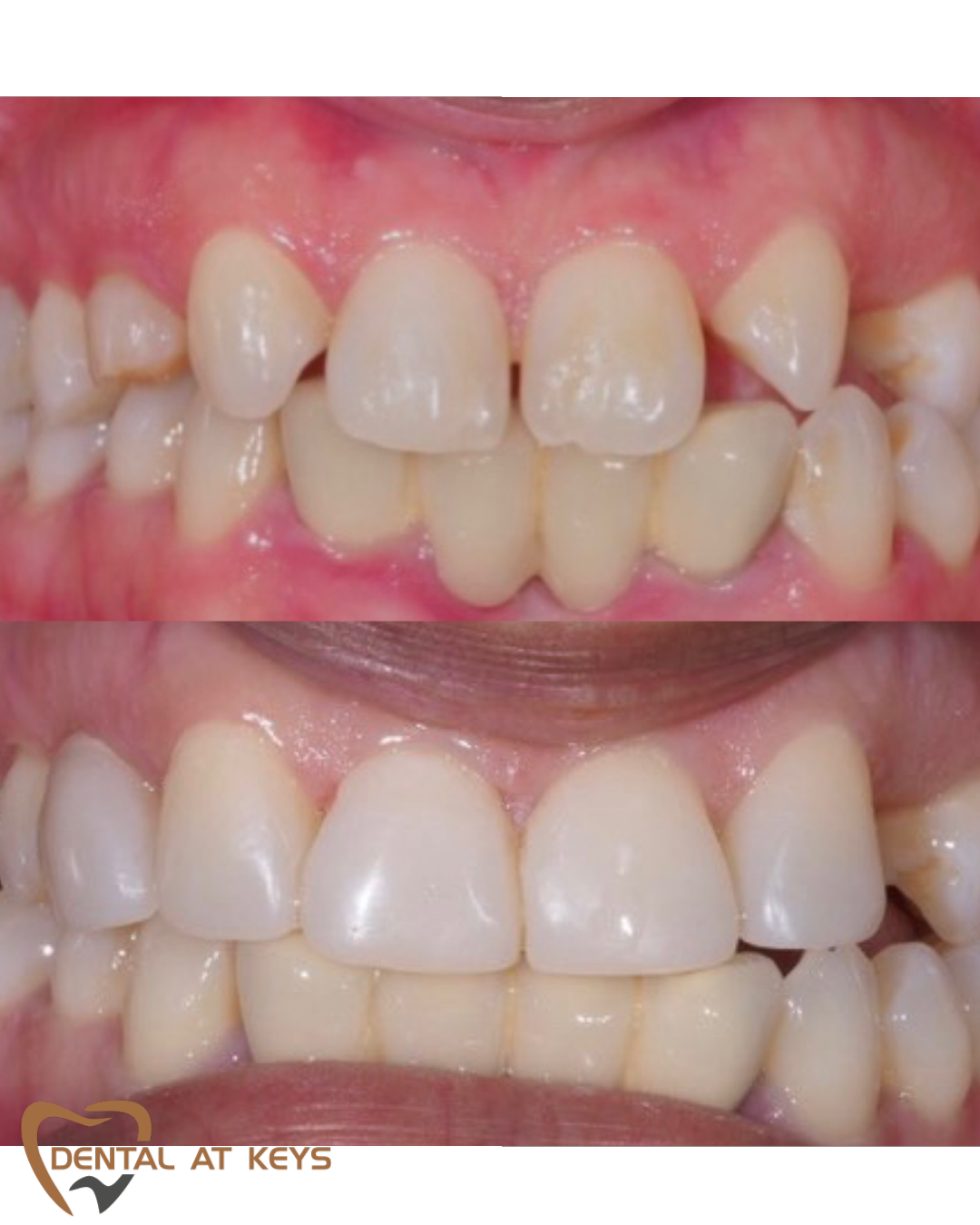 Composite Veneers