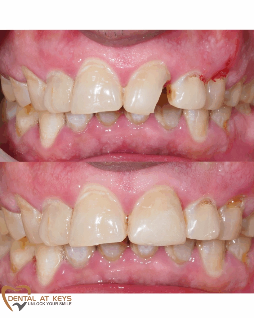 Composite Resin Dental at Keys