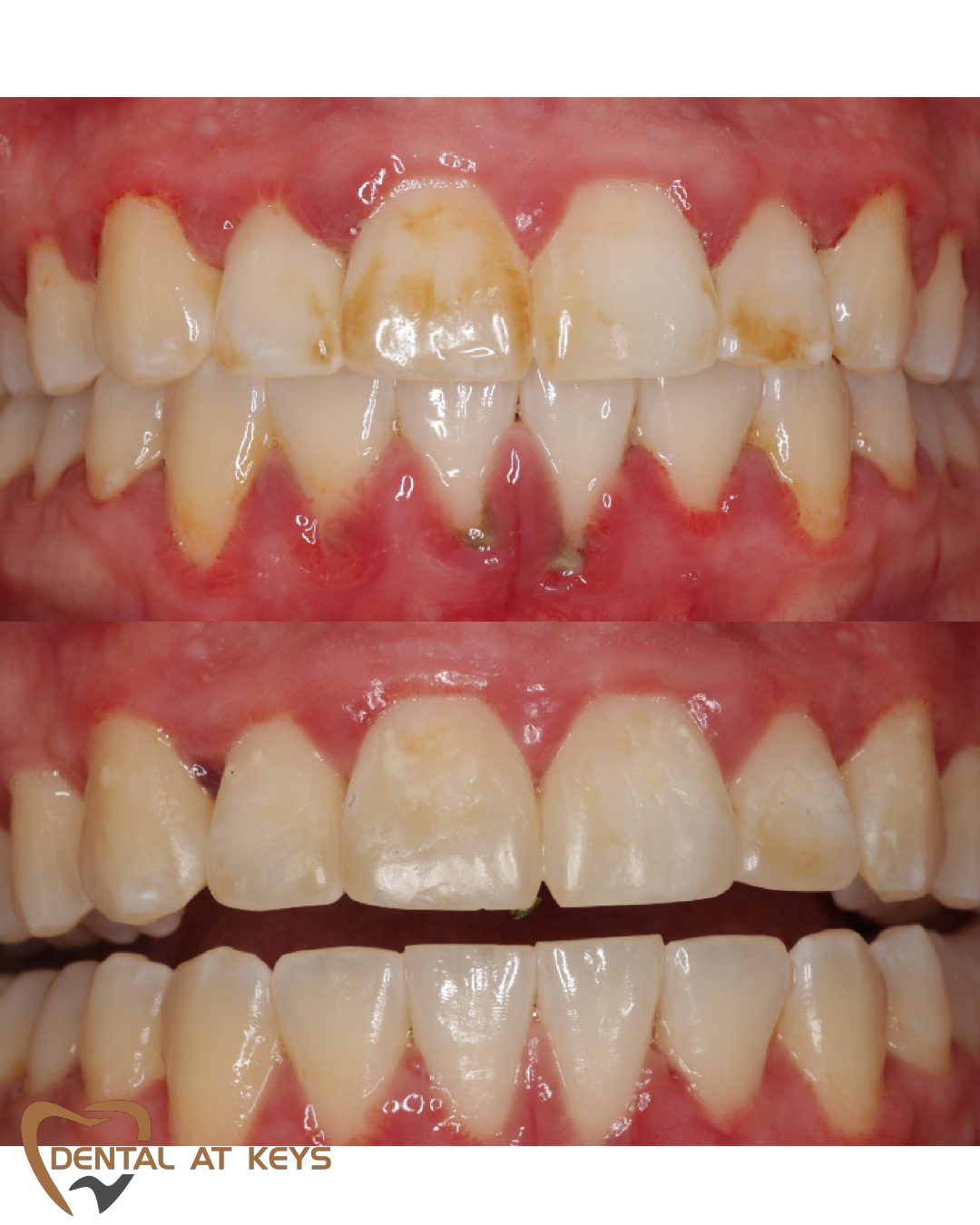 Before/After Enamel Microabrasion