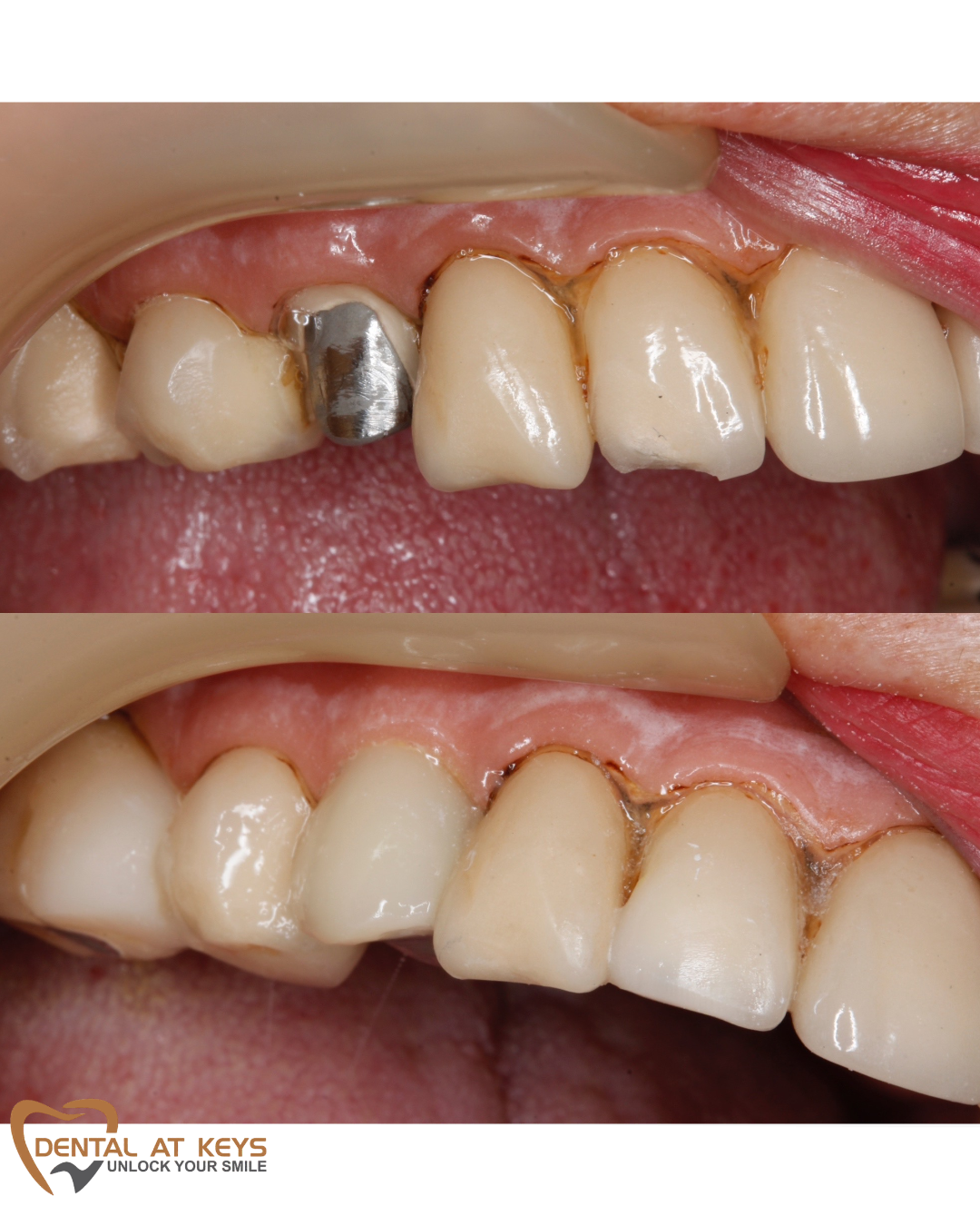 Check out these AMAZING results – Implant Crown repair!