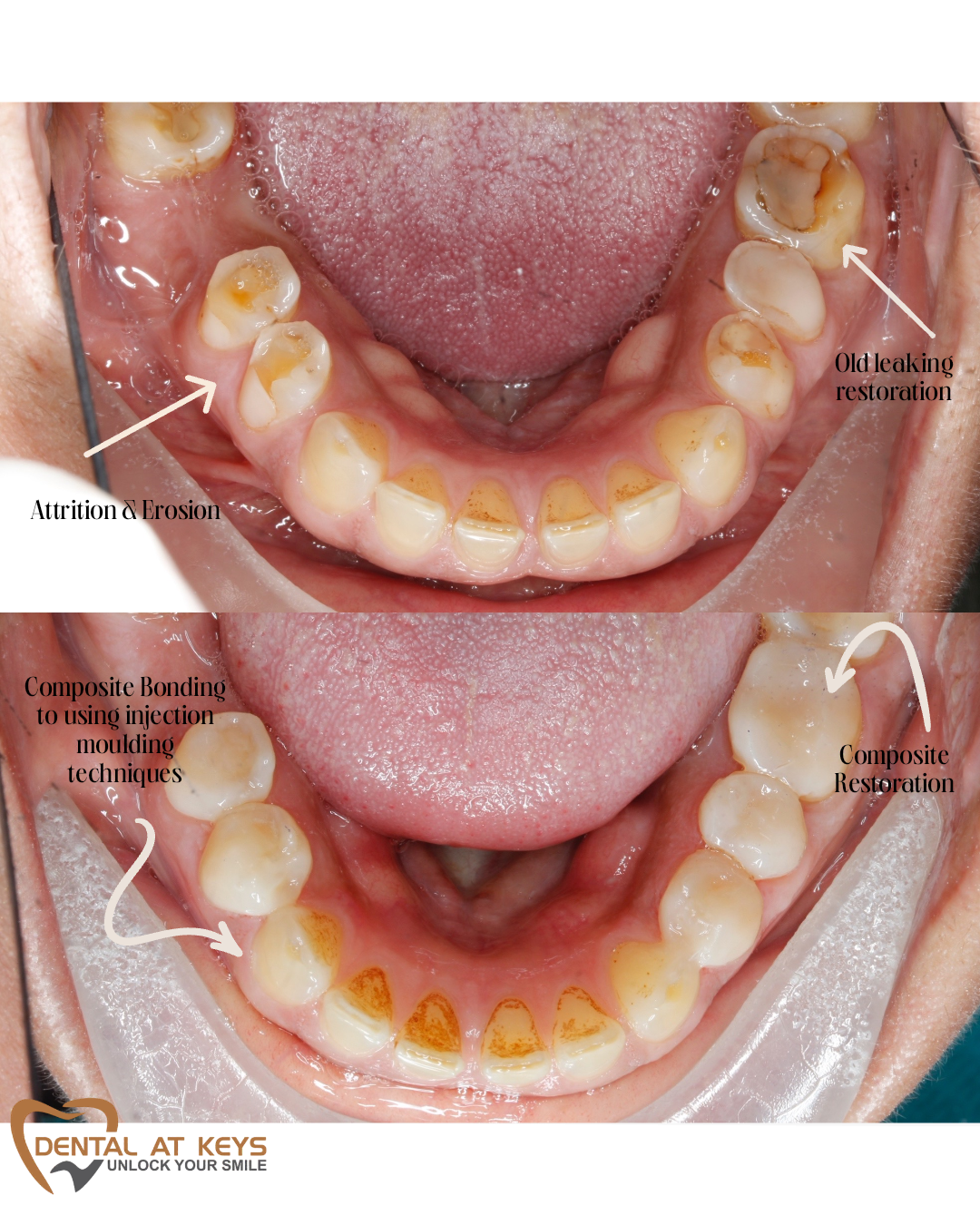 Look what we acheived with Composite Bonding!!