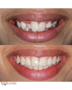 jaw expansion patient before after