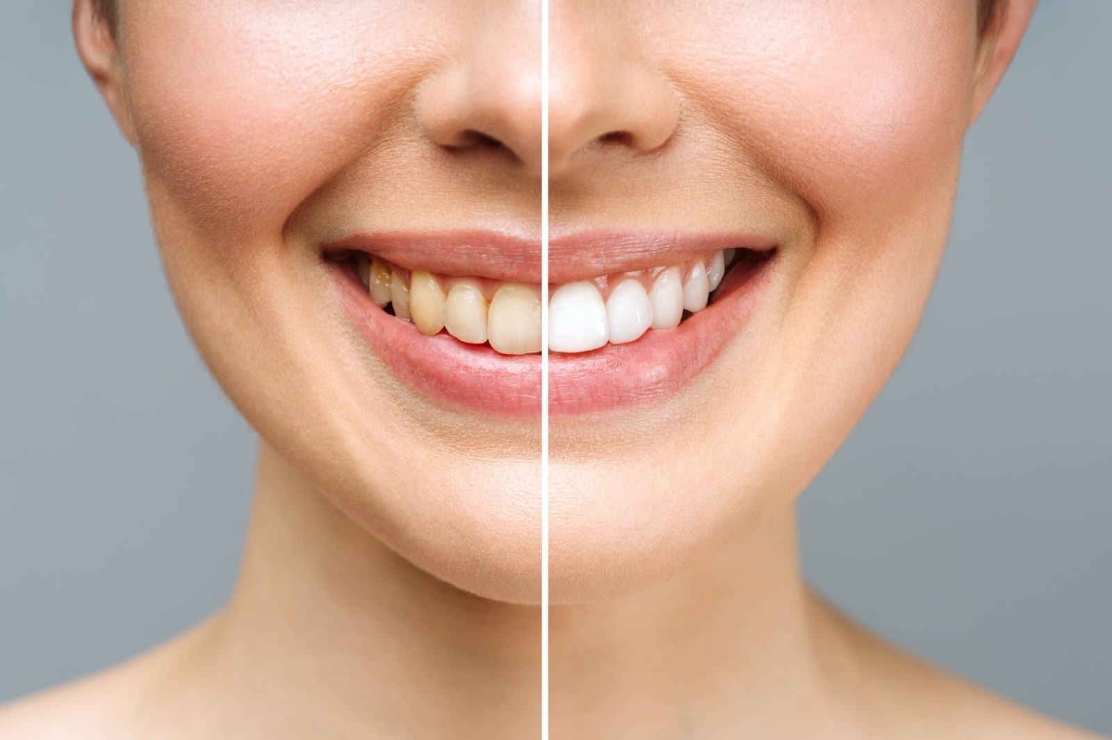 How To Whiten Teeth?