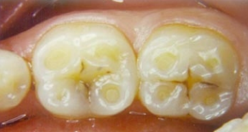 Enamel Erosion