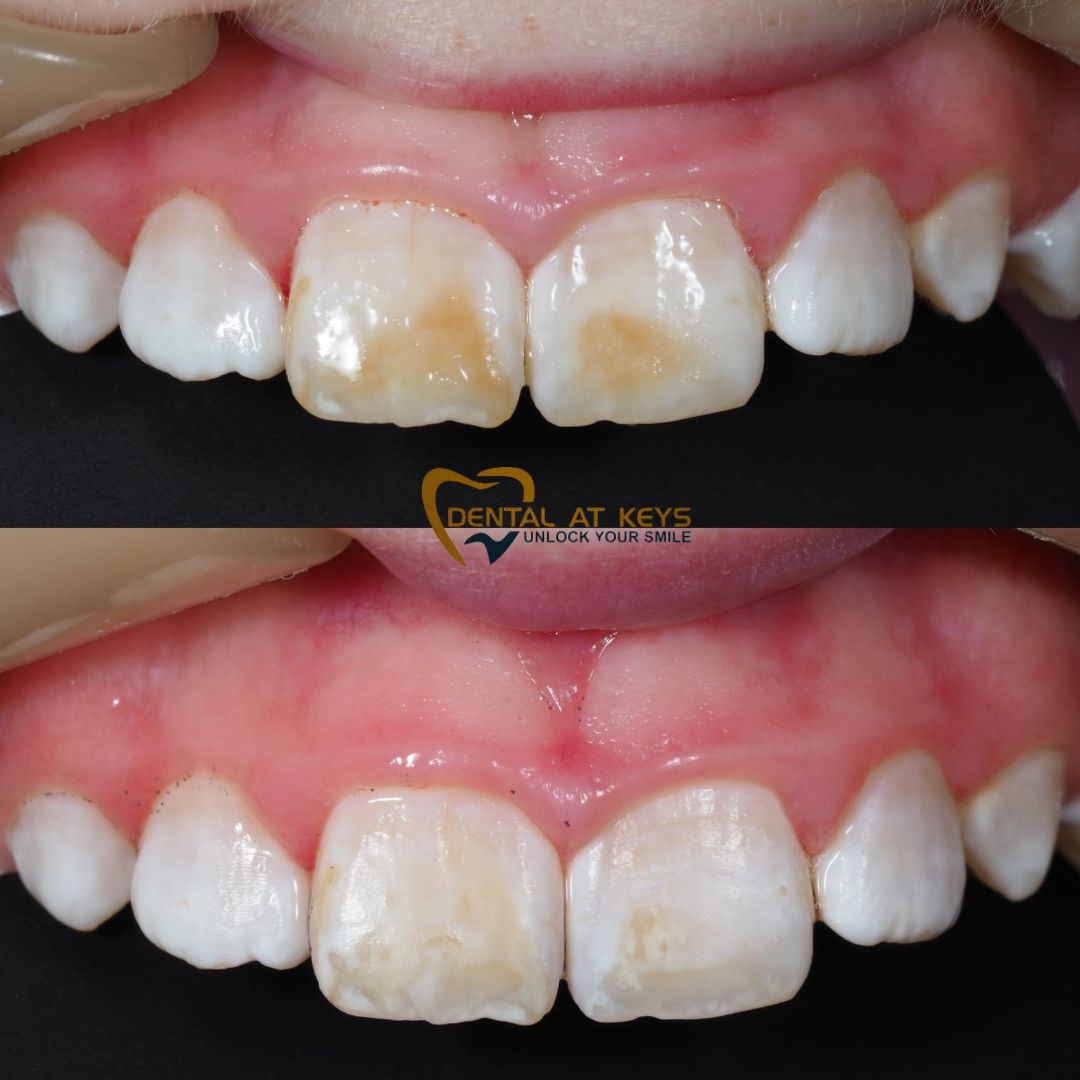 Say Goodbye to stubborn stains! (Enamel Microabrasion) 🦷