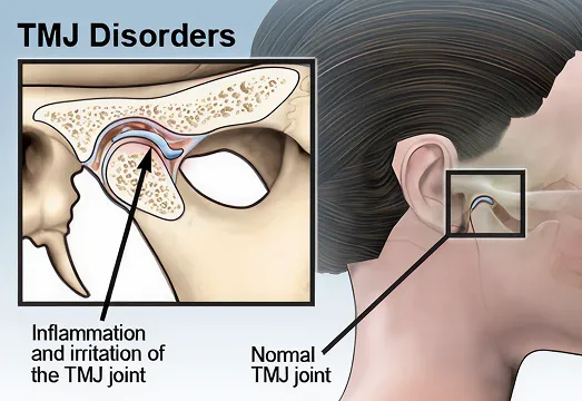TMJ and TMD infogram