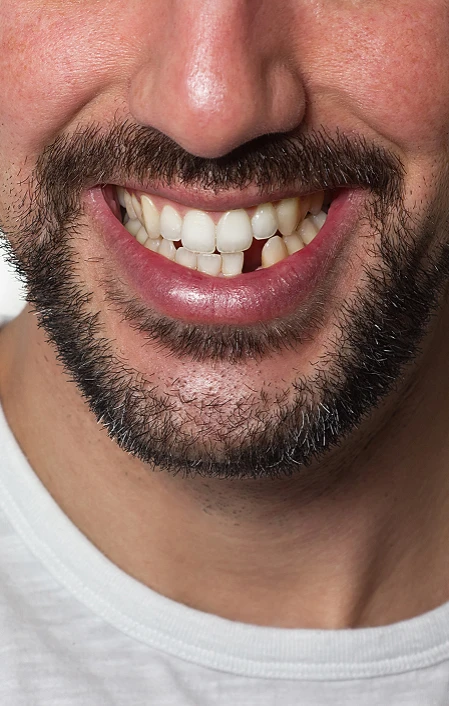 man with missing tooth needs a dental implant