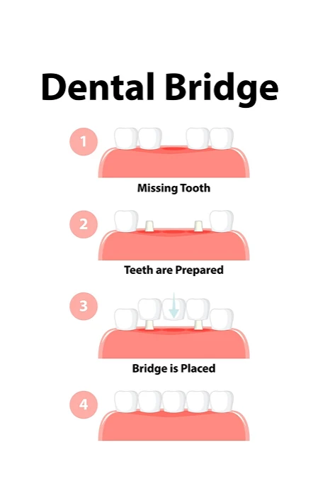 dental tooth bridge infogram