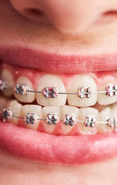 close up of orthodontics braces