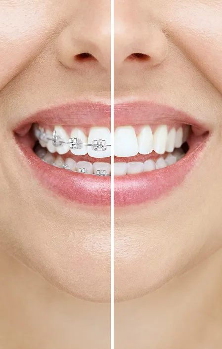 braces vs clear aligners
