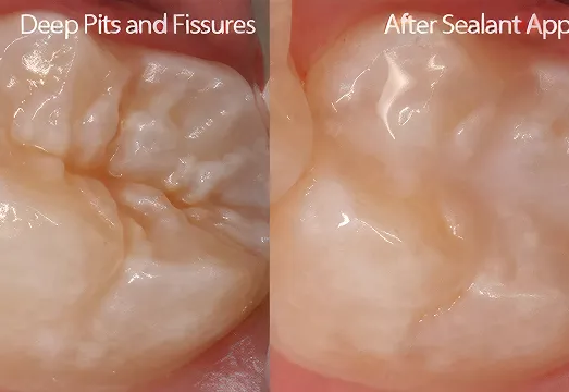 before after fissure sealants