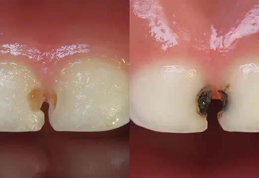 silver diamine fluoride treatment before after