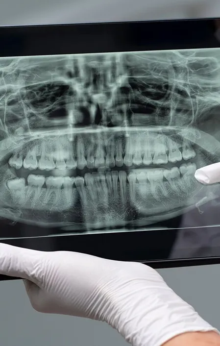 dental OPG x-ray need tooth extractions