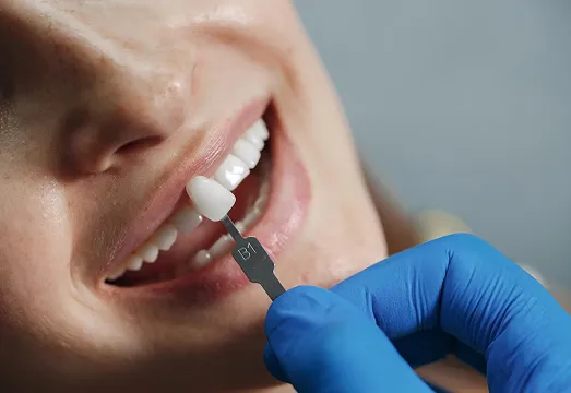 choosing tooth colour for cosmetic dental work