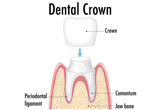 Dental crown infogram