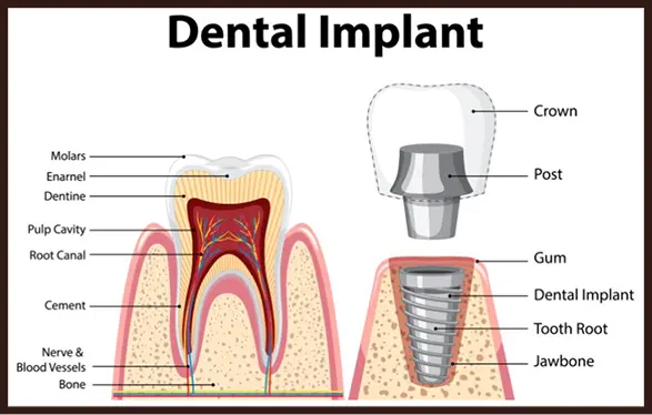 Dental Implant Infogram
