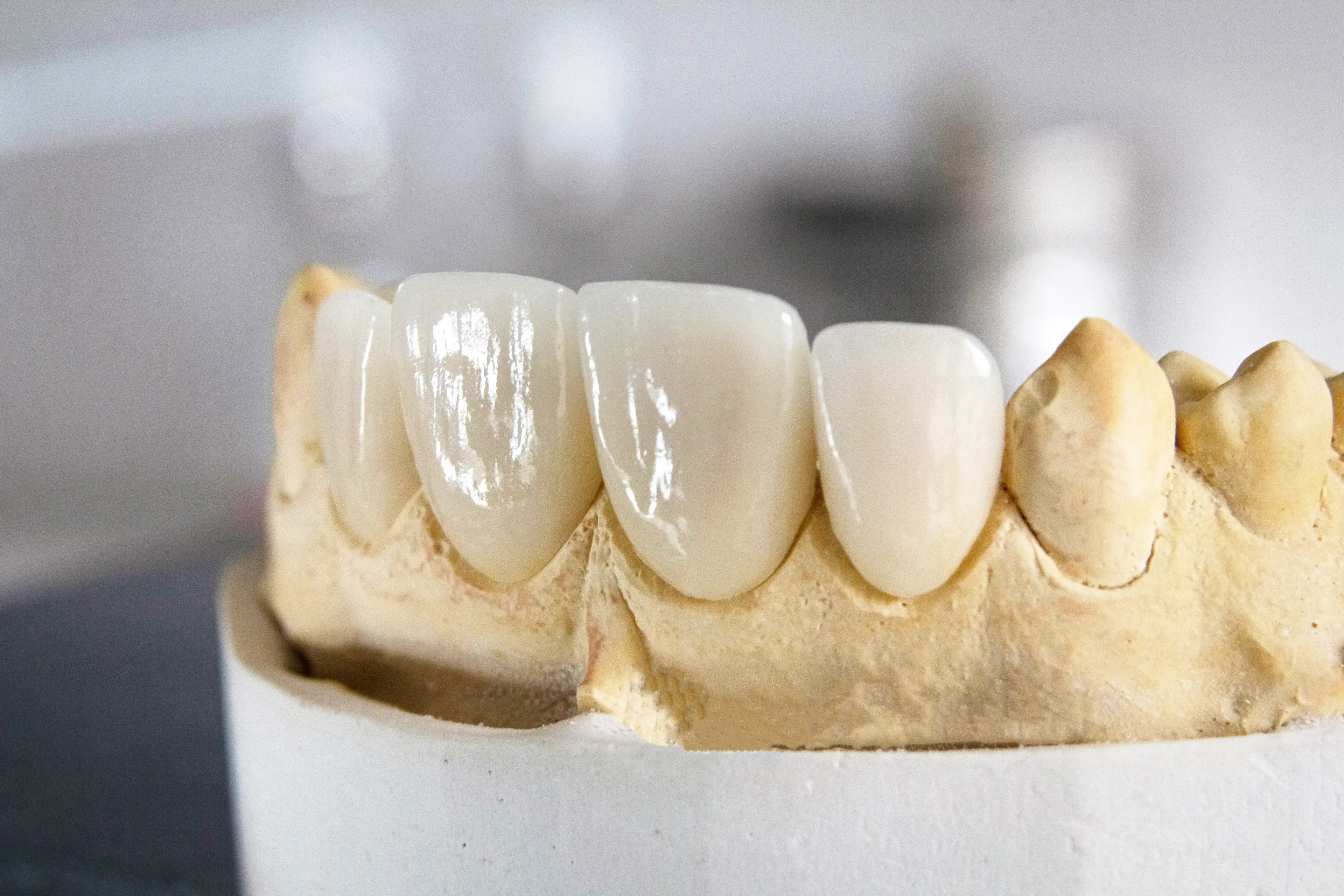 anterior dental crowns veneers on stone dental model