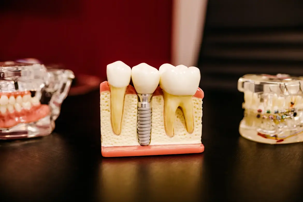 Dental Implants plastic model