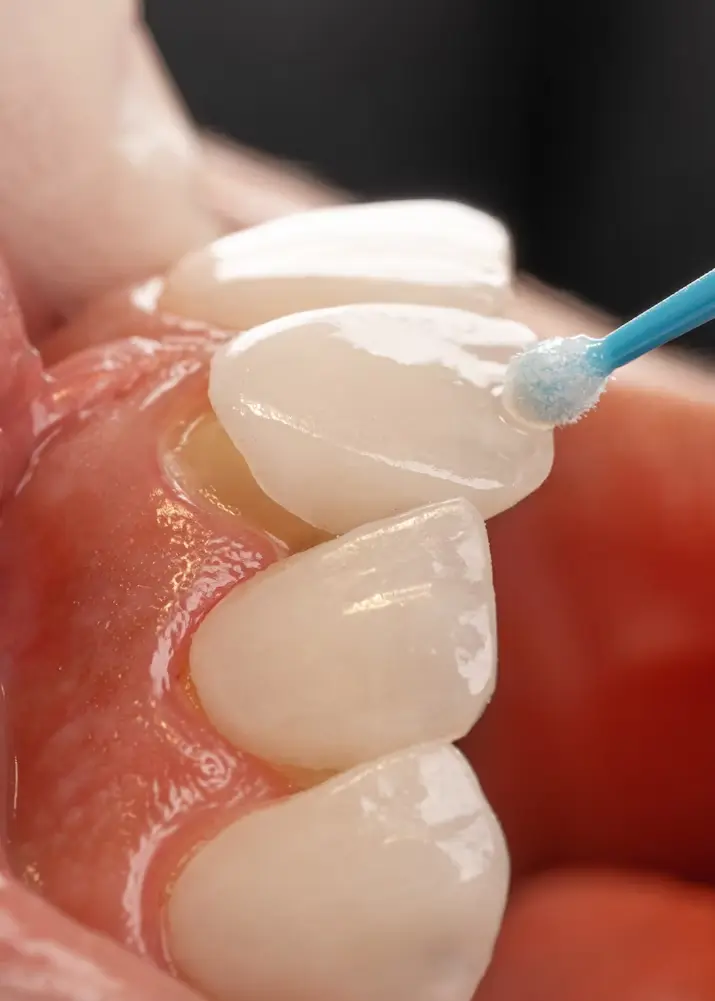 bonding dental veneer onto teeth close-up