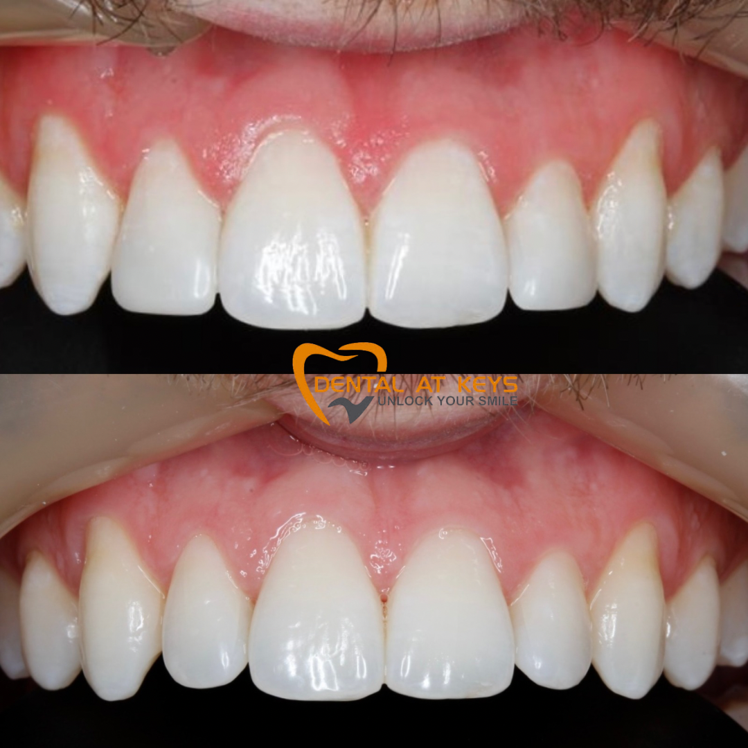 Subtle enhancements with Composite bonding 🦷