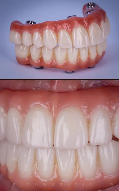 Full Mouth Dental Implants Example By Dr Poli