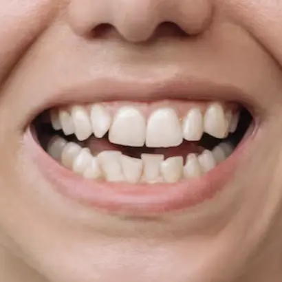 Woman With Crowded Teeth Thumbnail