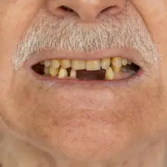 Man Close Up Missing Lower Teeth Thumbnail (thumbnail)